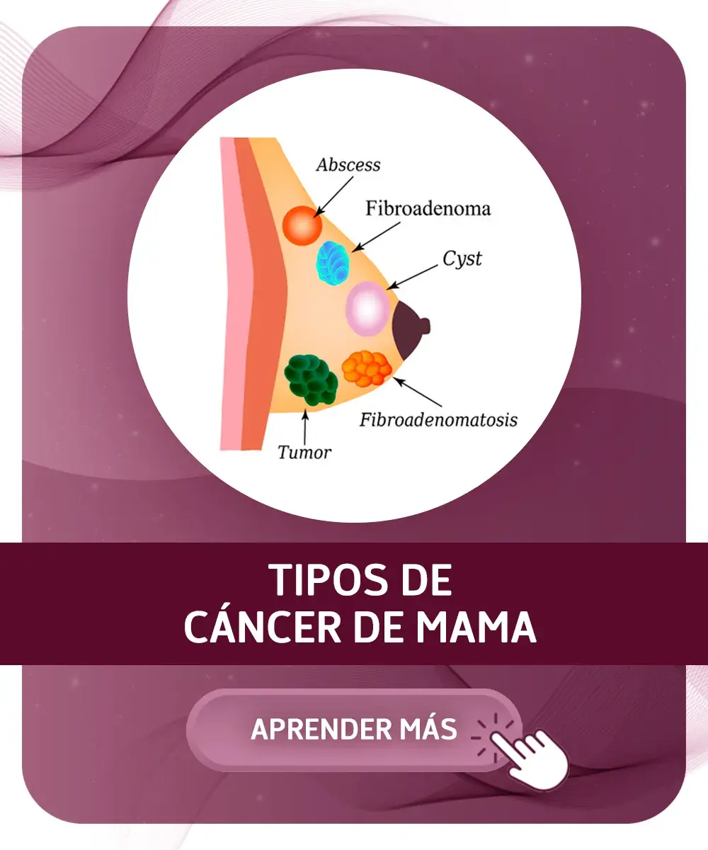 Enlace a tipos de cáncer de mama Enlace a tipos de cáncer de mama