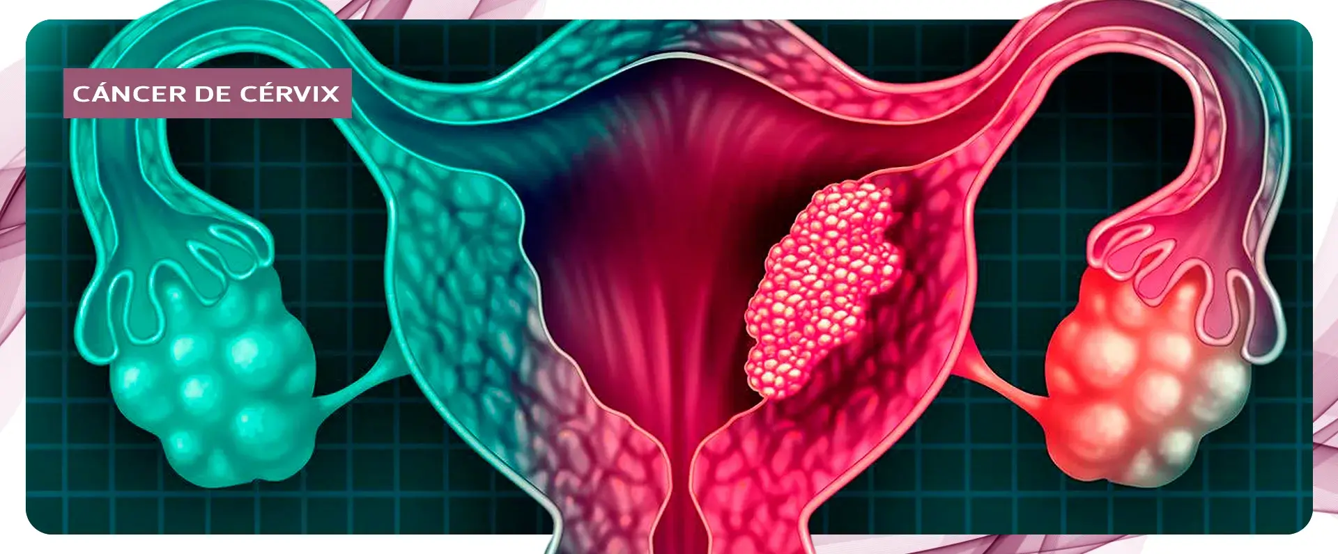 Masa tumoral en el cérvix Tumor que se localiza en la parte superior del cérvix