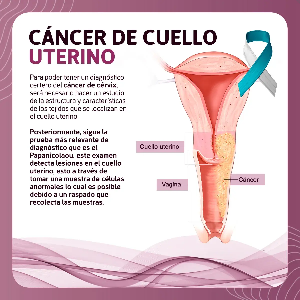 Detección del cáncer de cérvix La detección del cáncer de cérvix se hace mediante la toma de muestra de células
