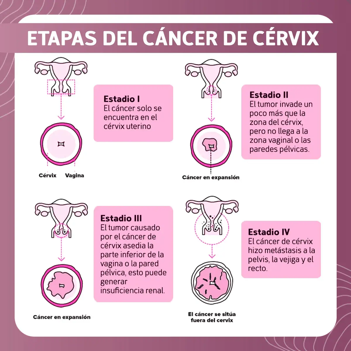 Etapas del cáncer de cérvix Etapas cáncer de cérvix (estadio I, II, III, IV)