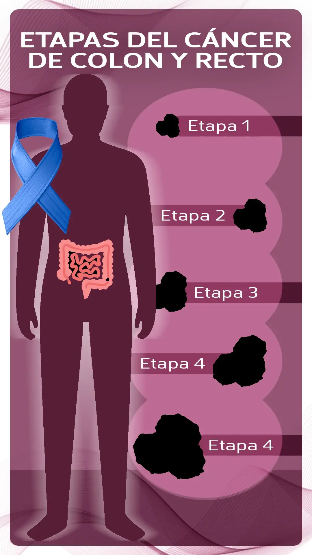 etapas del cáncer de colon y recto etapas del cáncer de colon y recto ( etapa 1, etapa 2, etapa 3, etapa 4).