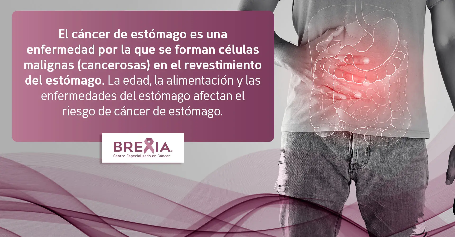 qué es el cáncer de estómago El cáncer de estómago es una enfermedad que forma células malignas en el revestimiento del estómago. (Riesgos por edad, alimentación)