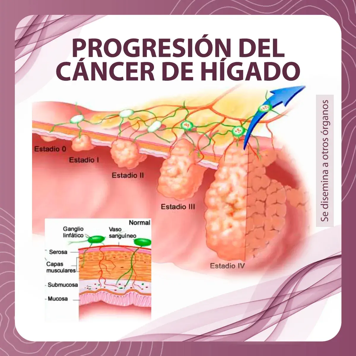 progresión cáncer de hígado Progresión de los estadios del cáncer de hígado. (Estadio 0, I, II, III, IV)