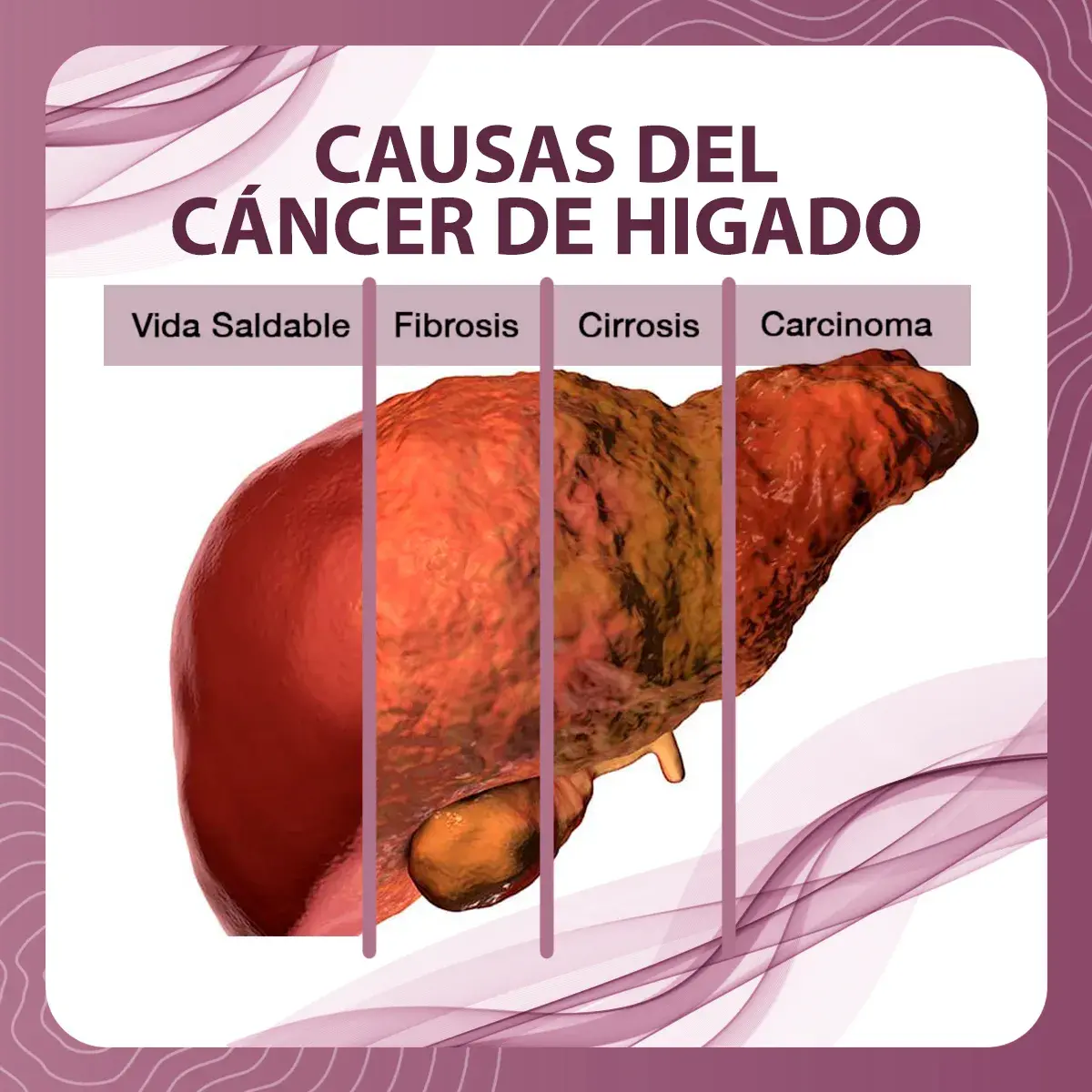 desarrollo cáncer de hígado El cáncer de hígado pasa por un desarrollo en el cual primero el órgano está sano, posteriormente pasa por la fibrosis, cirrosis y al final el carcinoma