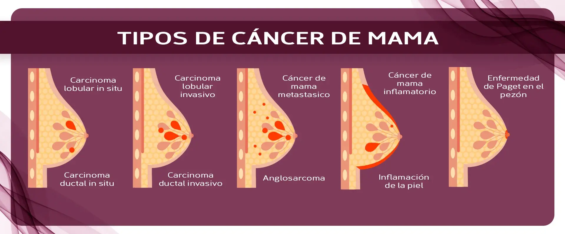 Tipos de cáncer de mama Tipos de cáncer de mama (cáncer lobular, cáncer ductal in situ, cáncer lobular y ductal invasivo, angiosarcoma, cáncer de mama inflamatorio, cáncer de mama triple negativo, enfermedad de Paget)