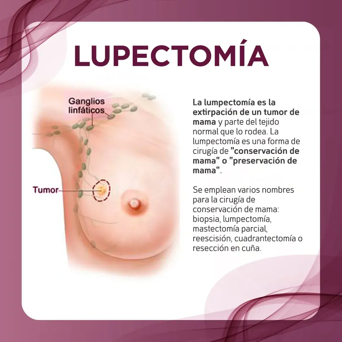 Mastectomía radical La cirugía conocida como mastectomía radical no conserva nada de la mama
