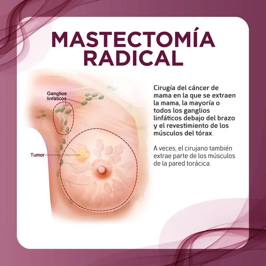 Cirugía de lupectomía la lupectomía es la cirugía que conserva la mama