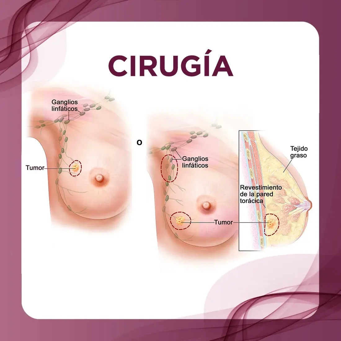 Cirugía cáncer de mama Cirugía, tratamiento para el cáncer de mama