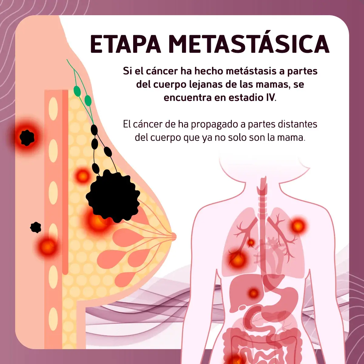 Etapa metastásica del cáncer de mama avanzado El cáncer de mama puede evolucionar a una etapa metastásica