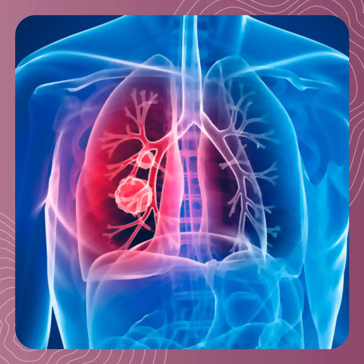 Tumor del cáncer de pulmón Tumor localizado en la cavidad pulmonar que se genera por el cáncer de pulmón