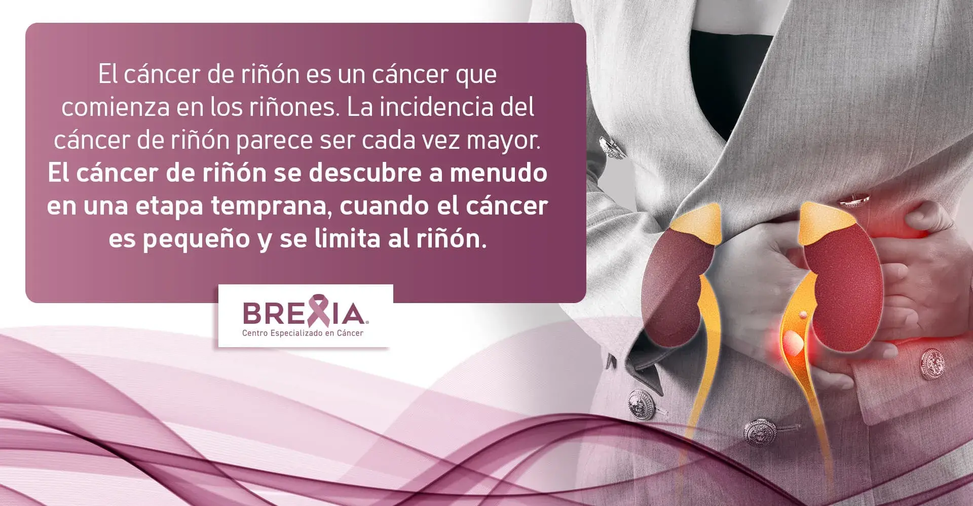 Cáncer de riñón localizado El cáncer de riñón suele descubrirse en una etapa temprana y localizada.