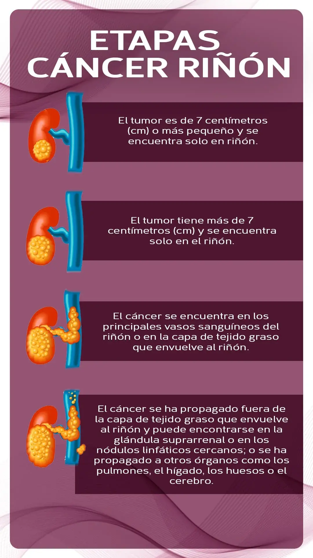 Etapas cáncer de riñón Las etapas del cáncer de riñon (I,II, III, IV)