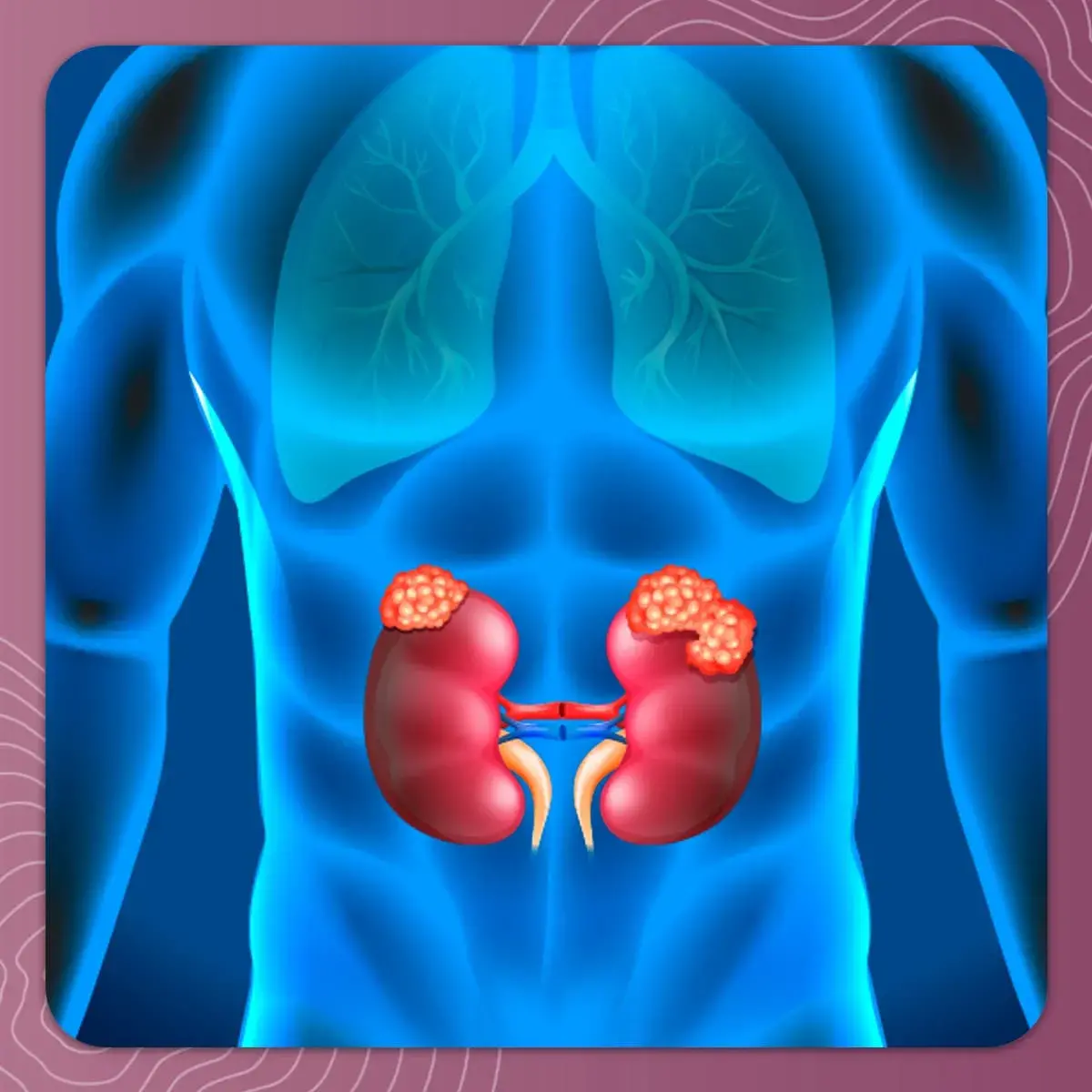 Lesiones en el riñón Lesiones que causa el cáncer en la parte superior del riñón.