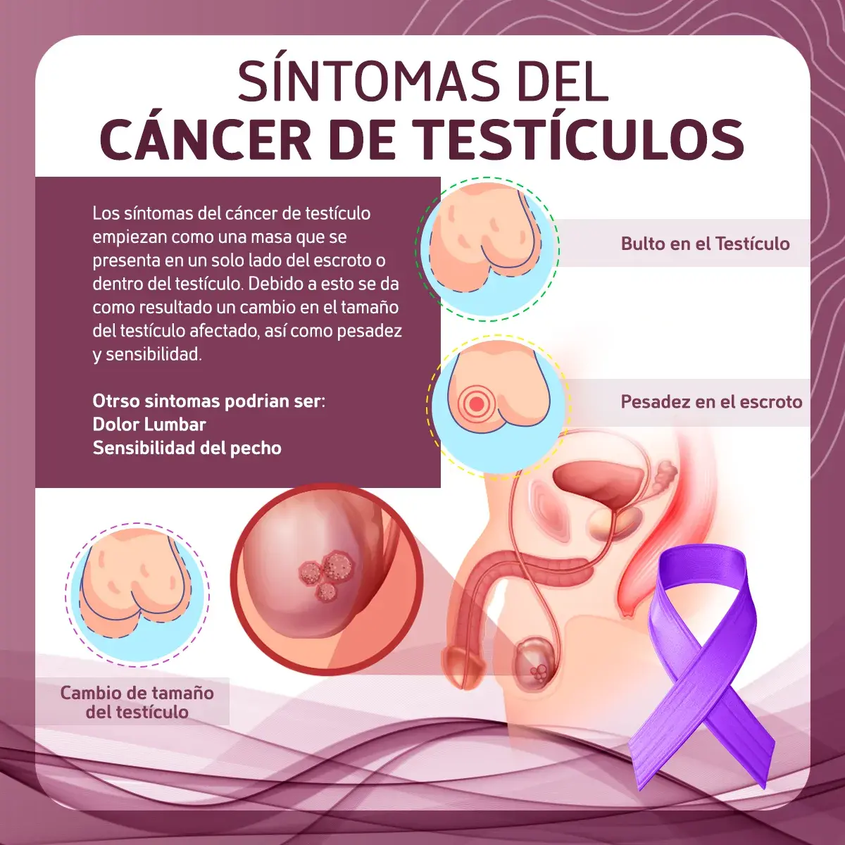 Síntomas del cáncer de testículos Síntomas del cáncer de testículos (bulto en el testículo, pesadez en el escroto, cambio de tamaño)