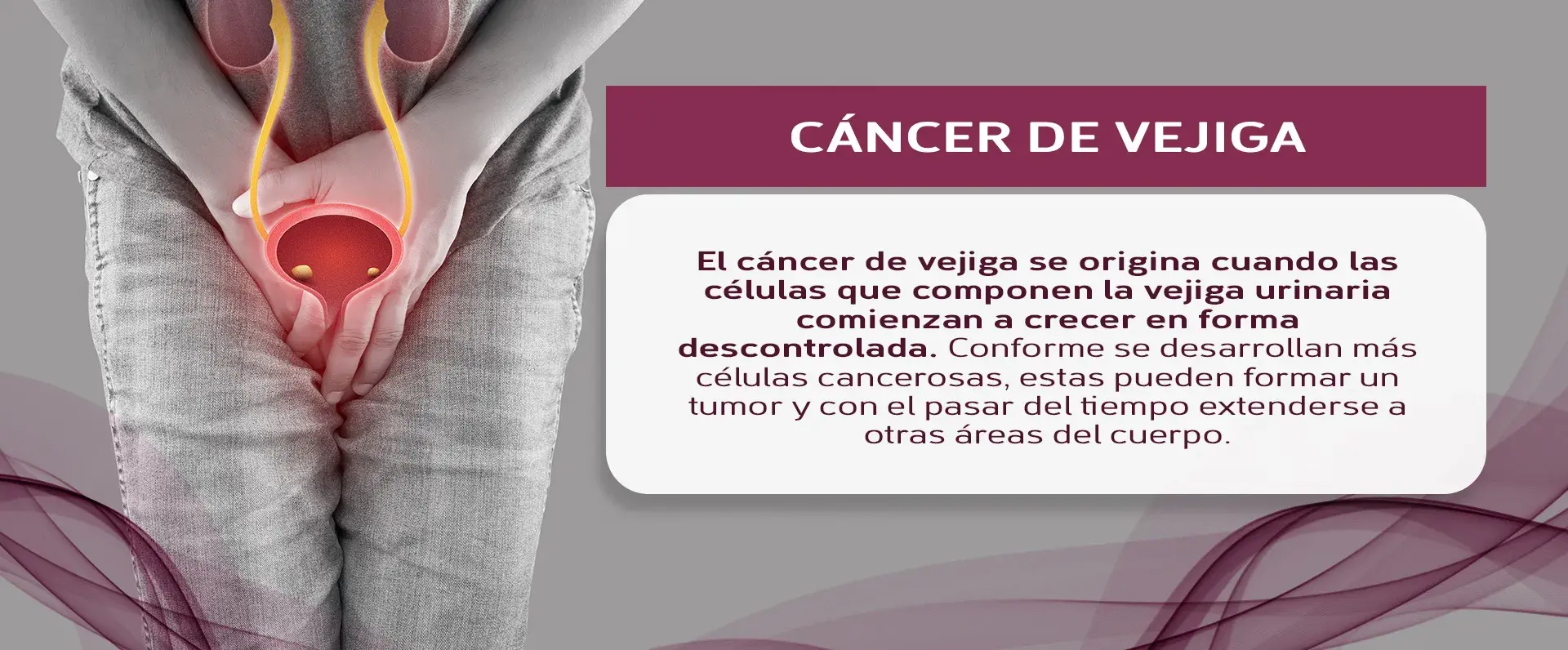 crecimiento cáncer de vejiga Crecimiento de células malignas que provocan cáncer de vejiga.
