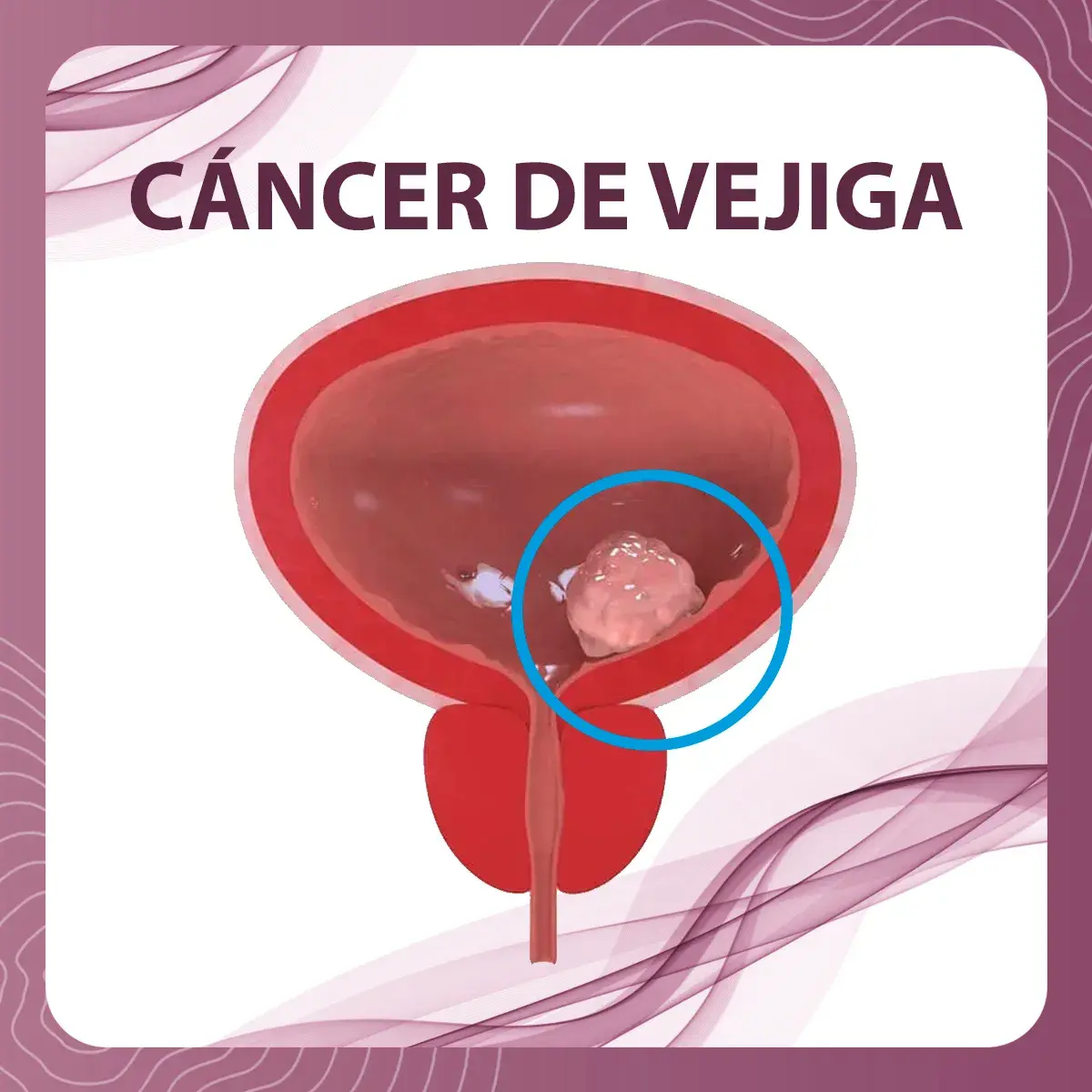 cáncer de vejiga cáncer en el lado derecho de la vejiga.