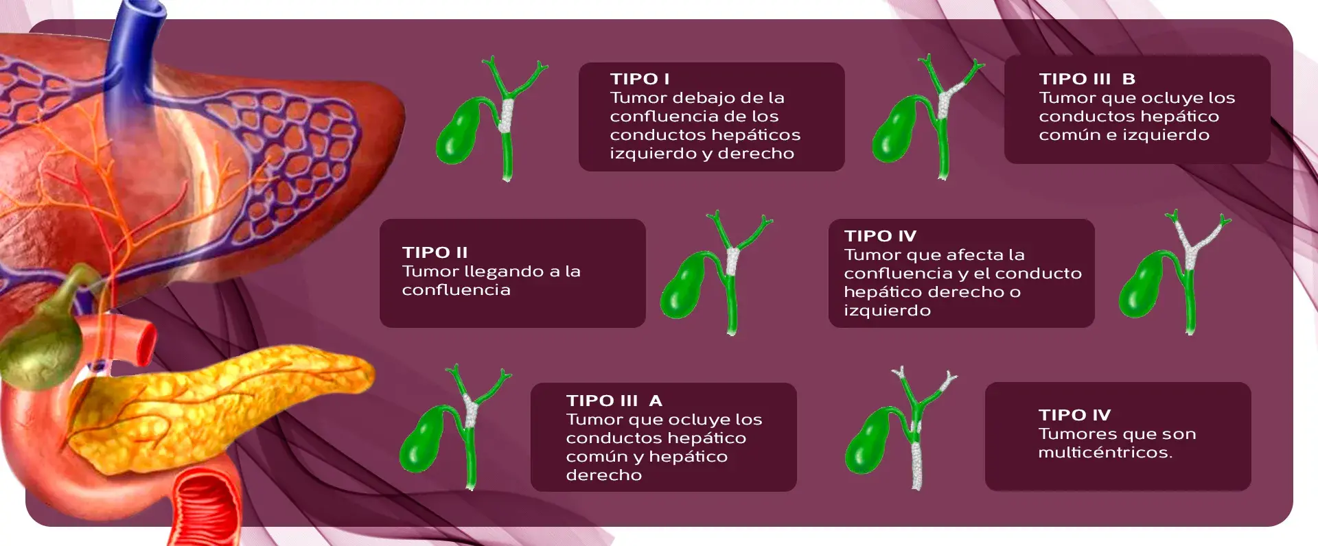 clasificación cáncer de vías biliares La clasificación del cáncer de vías biliares puede ser tipo I, tipo II, Tipo III A, IIIB, Tipo IV